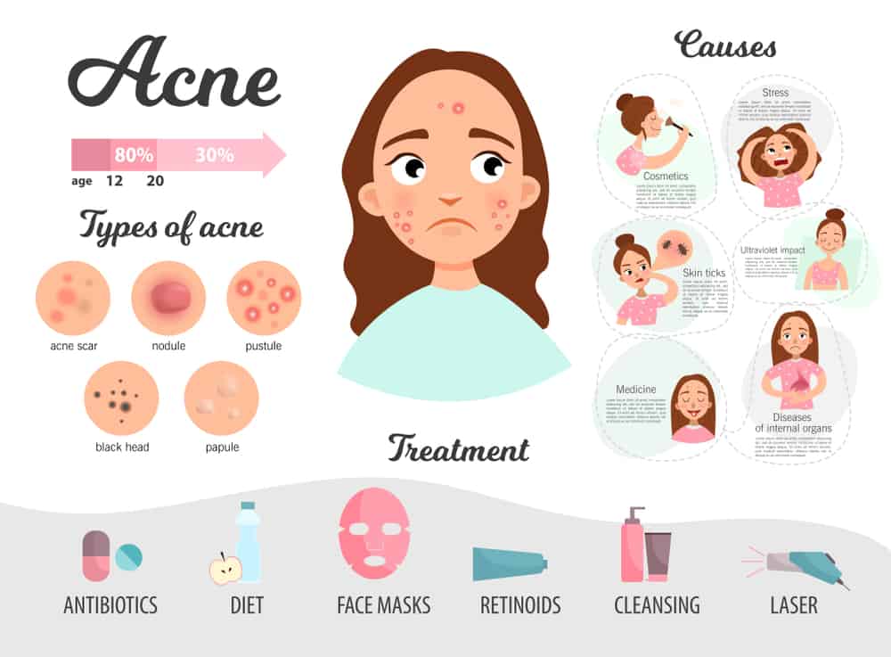 5 home remedies for acne treatment
